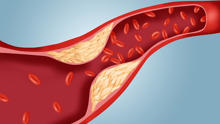 Actualización en el Tratamiento Nutricional y Farmacológico de las Dislipidemias